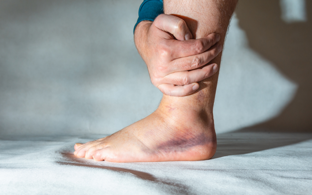 How Can You Differentiate Between a Sprain and a Strain Based on Their Characteristics and Treatment?