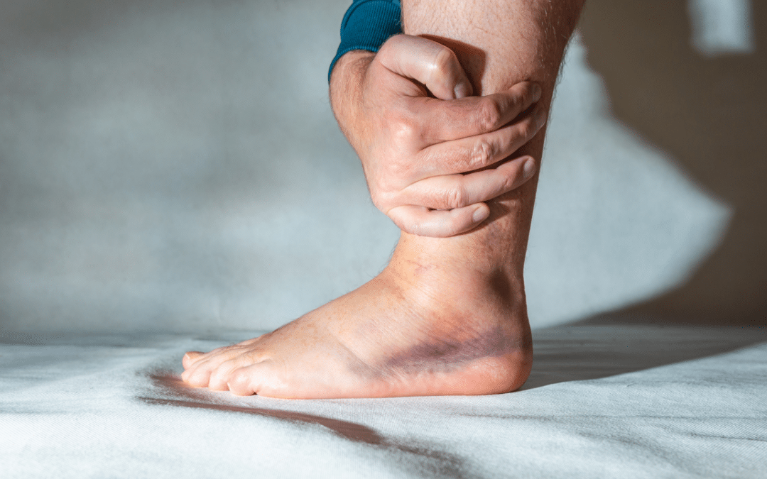 How Can You Tell If You’ve Sprained Something: Spotting the Signs Early