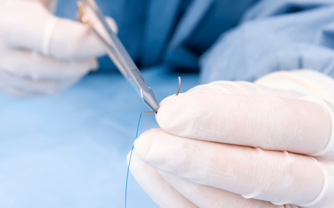 How Do Wound Stitches Dissolve?