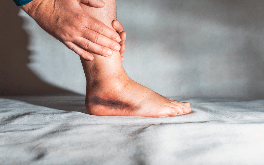 What Are the Essential Steps for Effective Sprain Recovery?