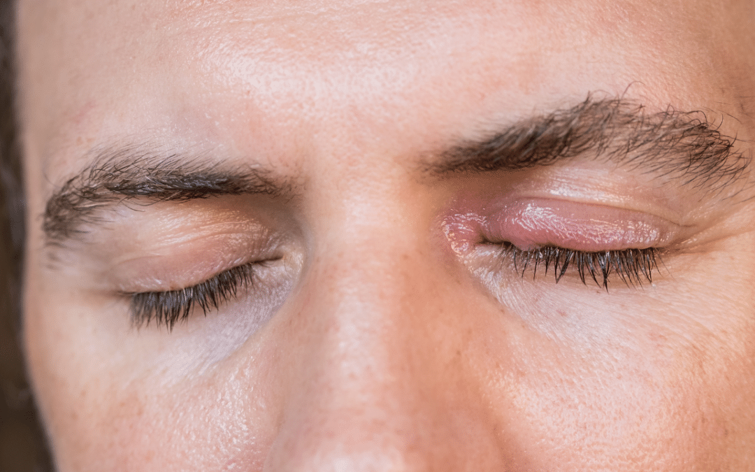 How Can You Effectively Manage and Alleviate the Symptoms of Viral Conjunctivitis?